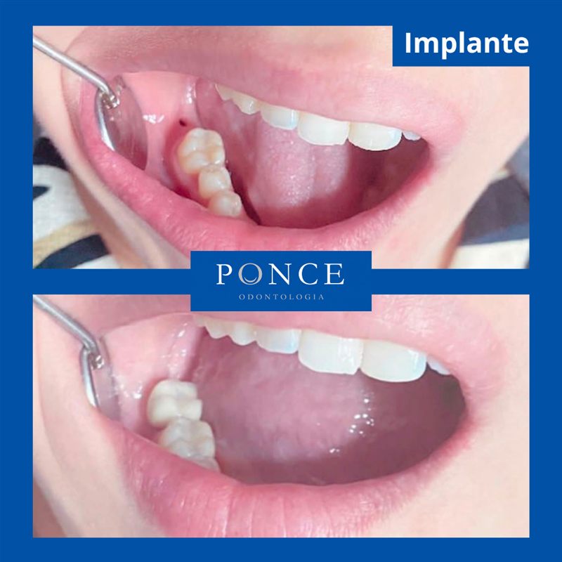 Antes e depois de implante dentário realizado pela Dra. Raquel Ponce em Niterói