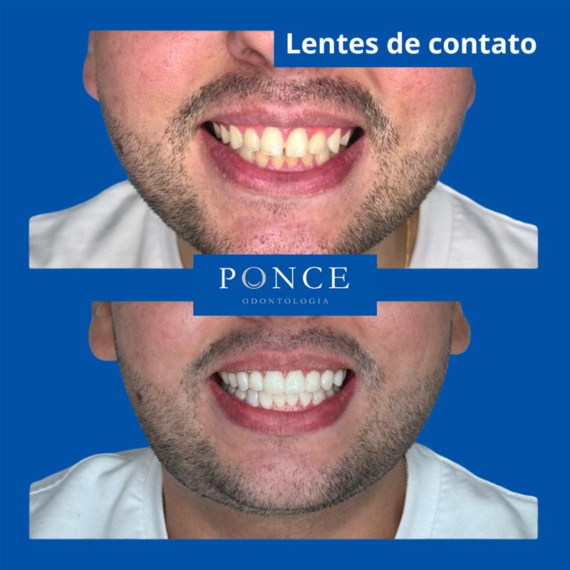 Antes e depois de lentes de contato dental aplicadas pela Dra. Raquel Ponce em Niterói
