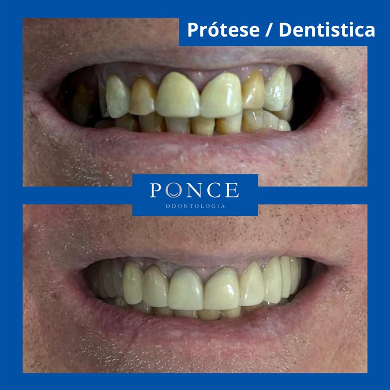 Antes e depois de prótese dentária e dentística realizadas pela Dra. Raquel Ponce em Niterói